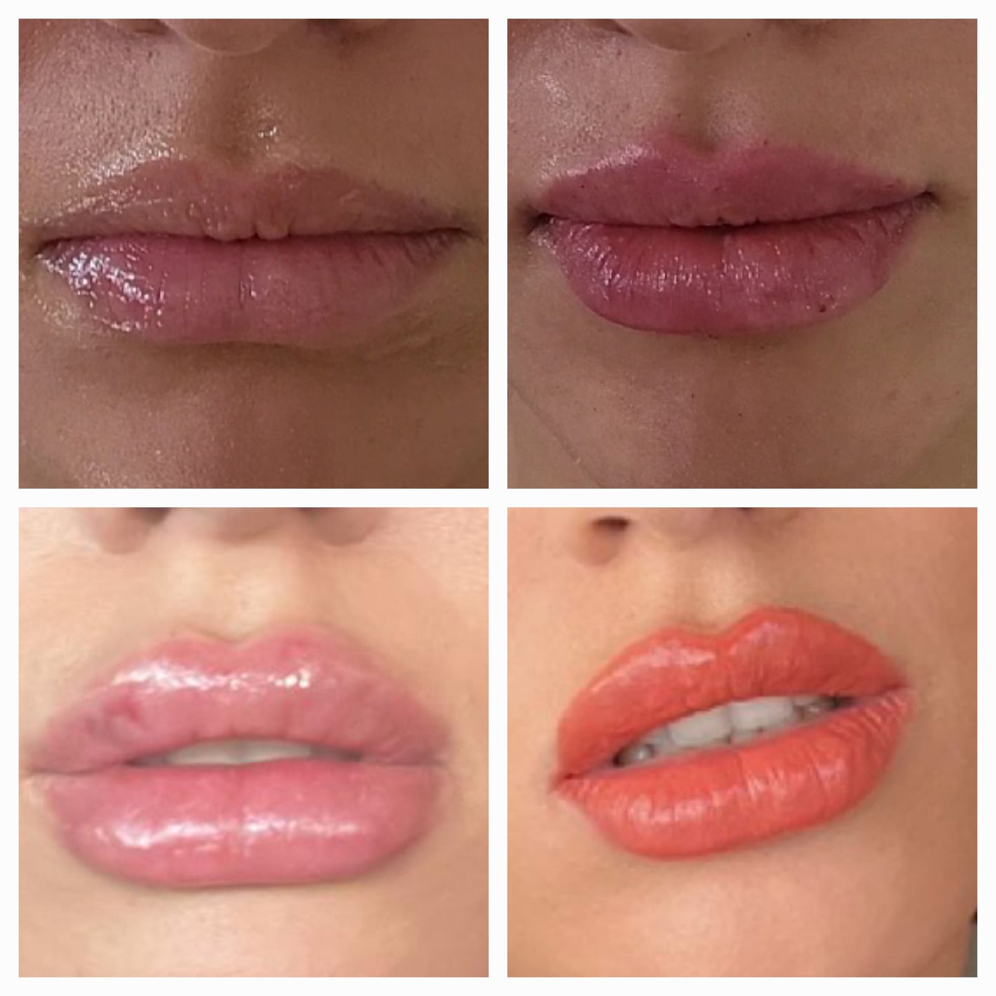 Dermal Fillers