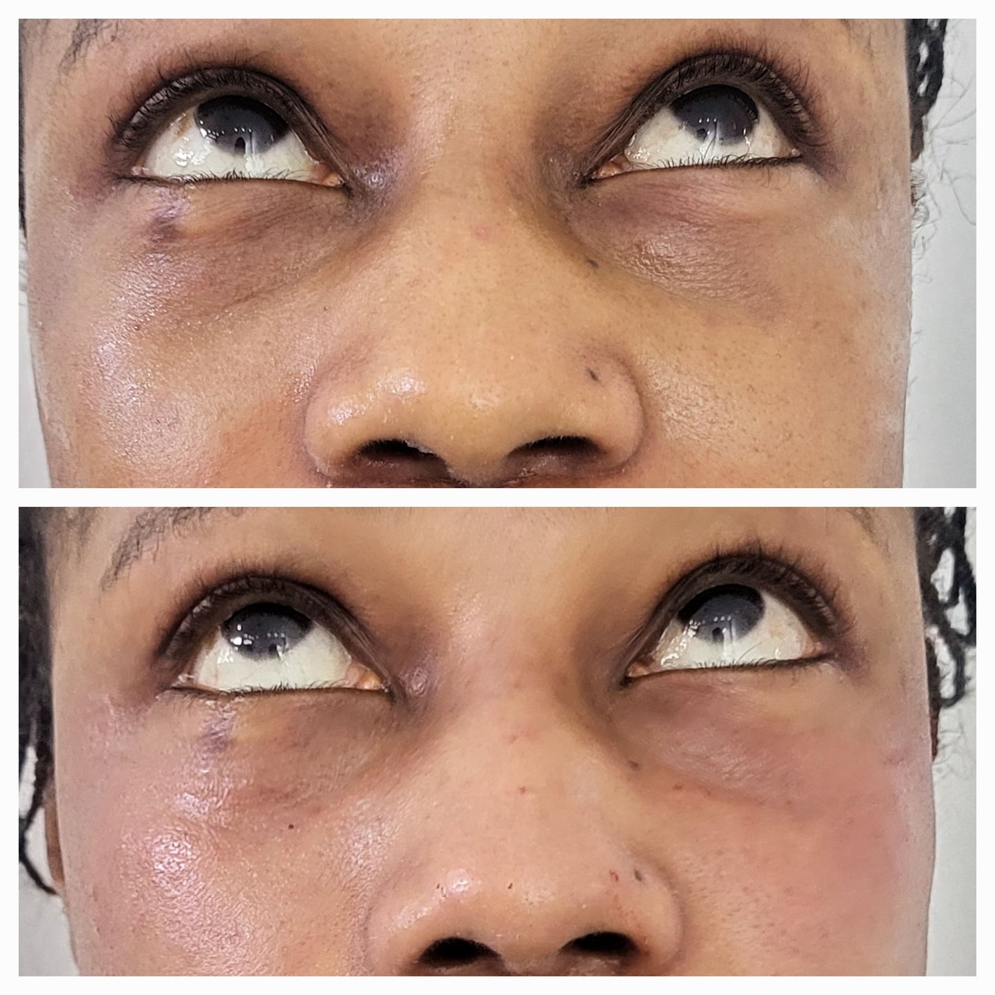 Dermal Fillers