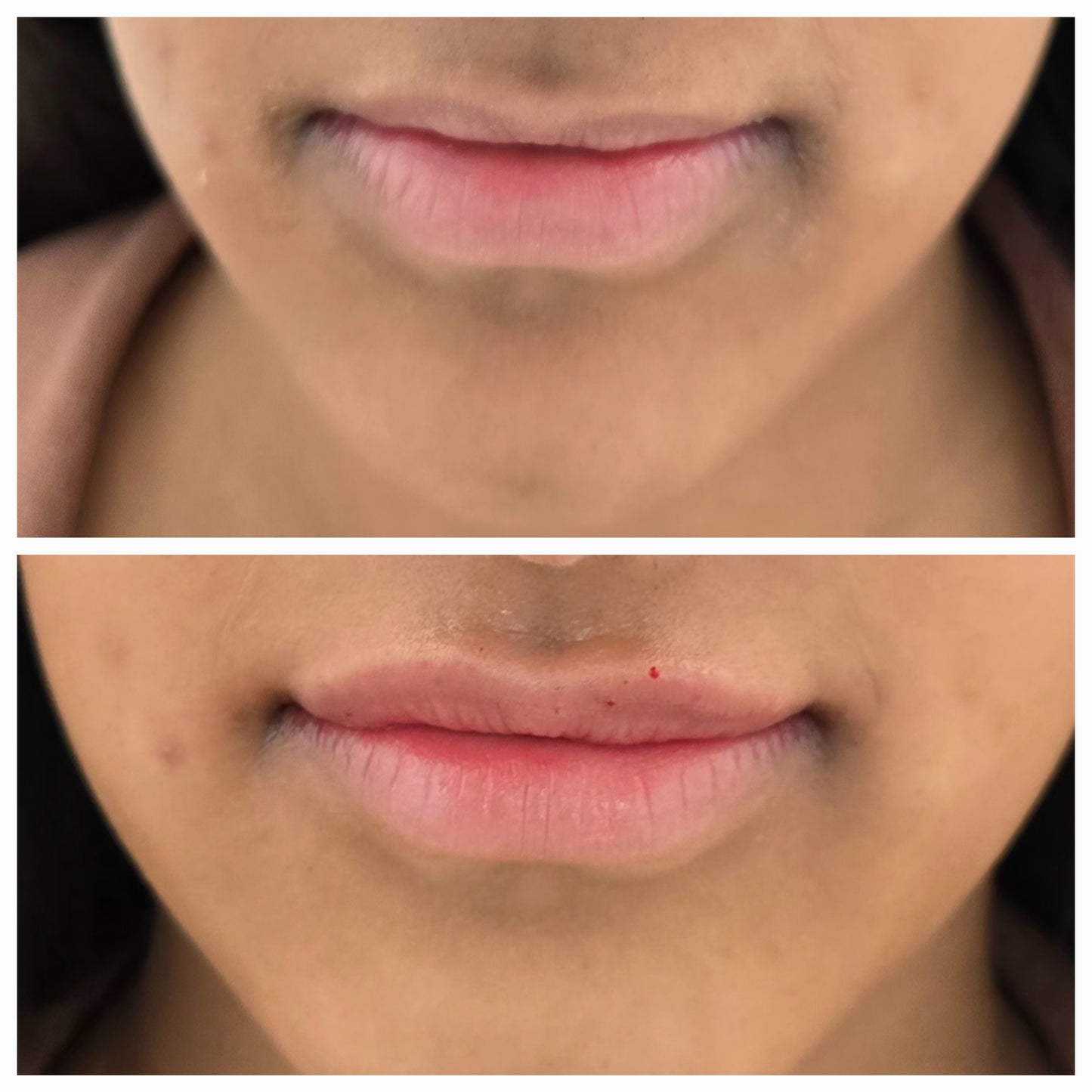 Dermal Fillers