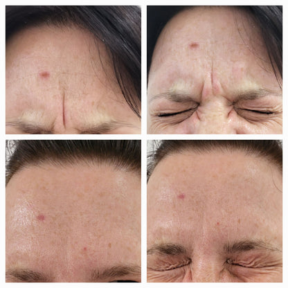 Botulinum Toxin