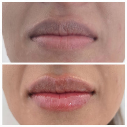 Dermal Fillers